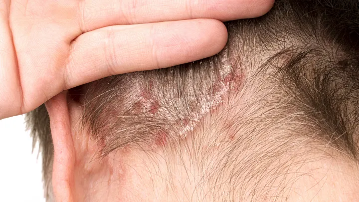 Schuppenflechte Kopfhaut: Ursachen, Symptome & Behandlung